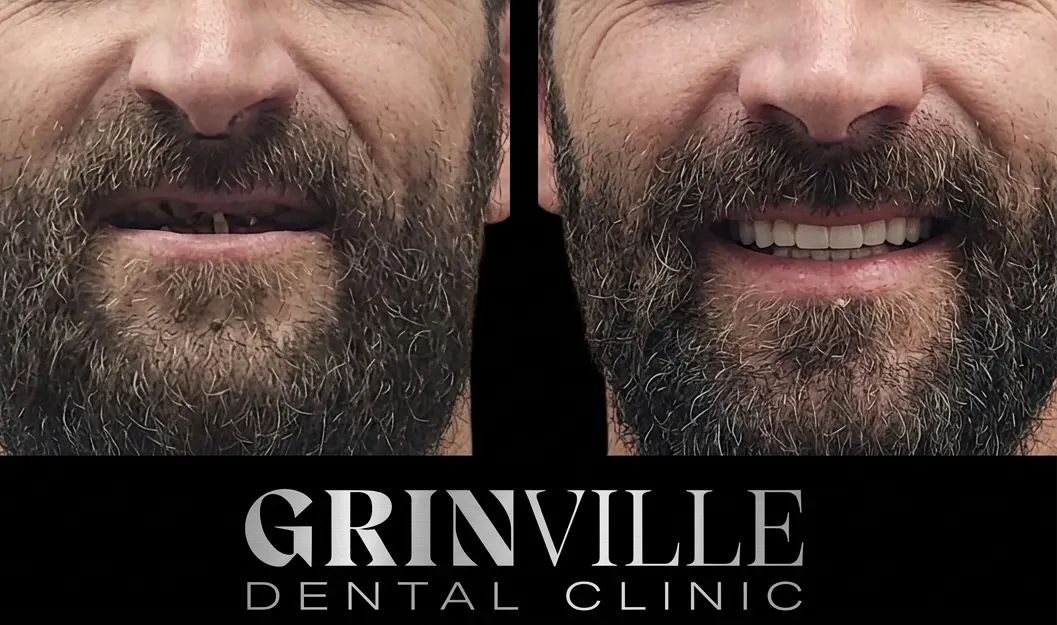 All on 4 before after 