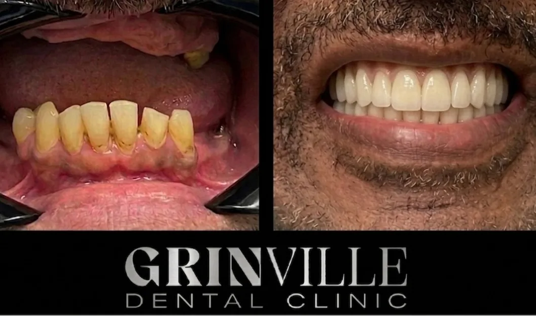 All on 4 before after 