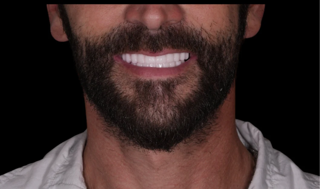 All on 4 before after 